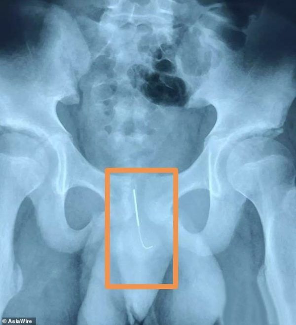 Un niño chino de 12 años se inserta una aguja de 11 centímetros en su uretra 1